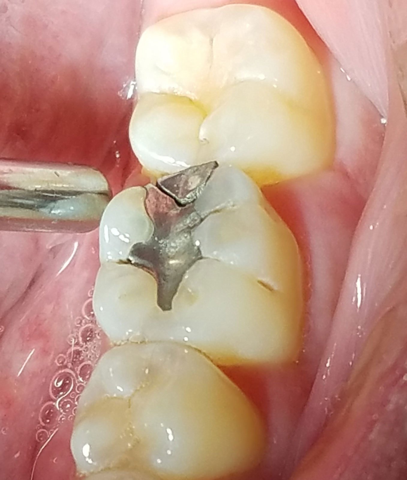 Răng Trám Bị Vỡ: Nguyên Nhân, Tác Hại Và Cách Xử Lý Hiệu Quả 2 Nguyên Nhân Gây Răng Trám Bị Vỡ