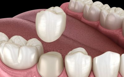 What is a dental crown and why is it needed?